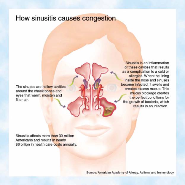 How Sinusitis Causes Congestions inmage