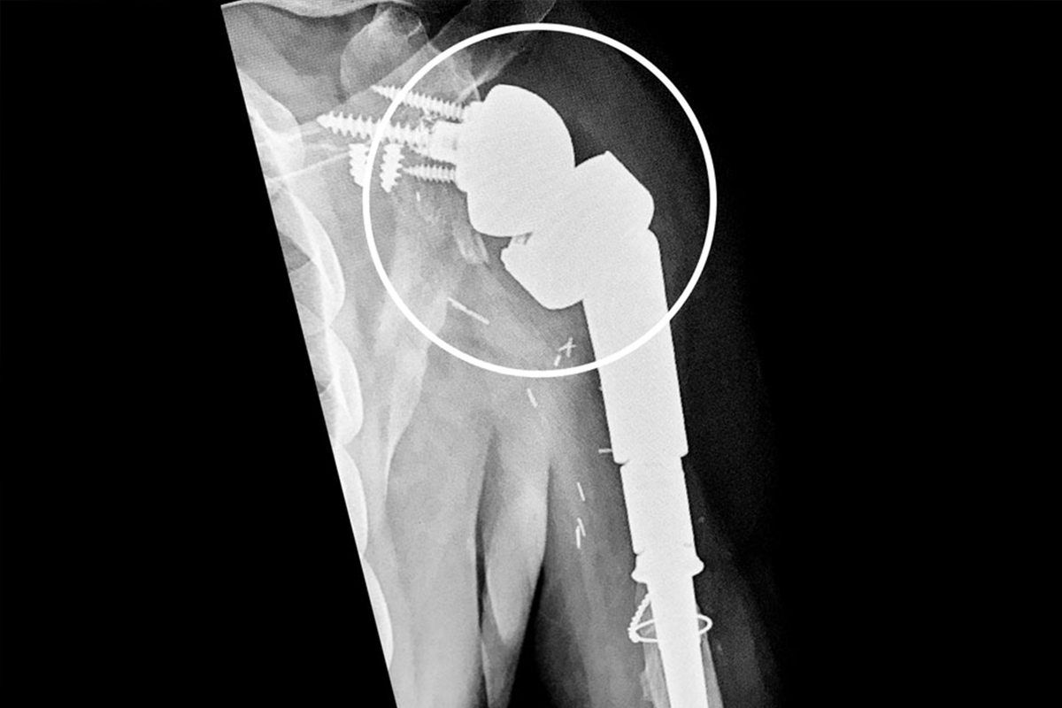 An x-ray showing Leonard Preston's newly-created shoulder replacement.