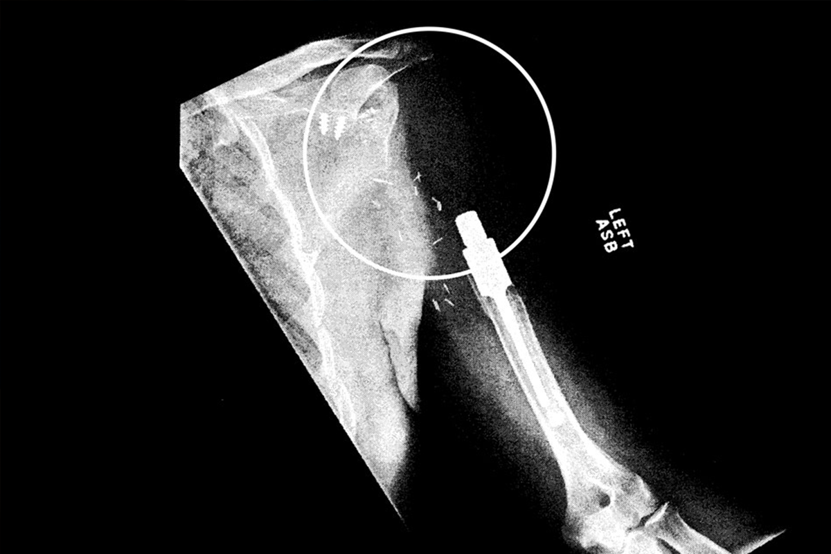 An x-ray of Leonard Preston's shoulder before restoration