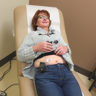 Lisa Conley shows the placement of her insulin pump on her abdomen.