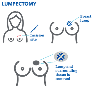 lumpectomy