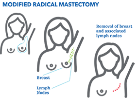 modified radical mastectomy