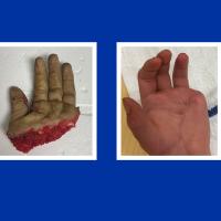 Levi Yoder's severed hand before and after surgery.