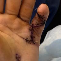 A close-up photo of Eli’s pinky after the surgery. Stitches that have turned purple run the length of his finger.