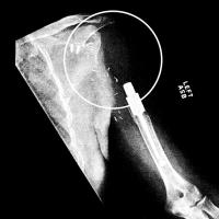 An x-ray of Leonard’s shoulder when he came to UK shows the gap in his skeletal system.